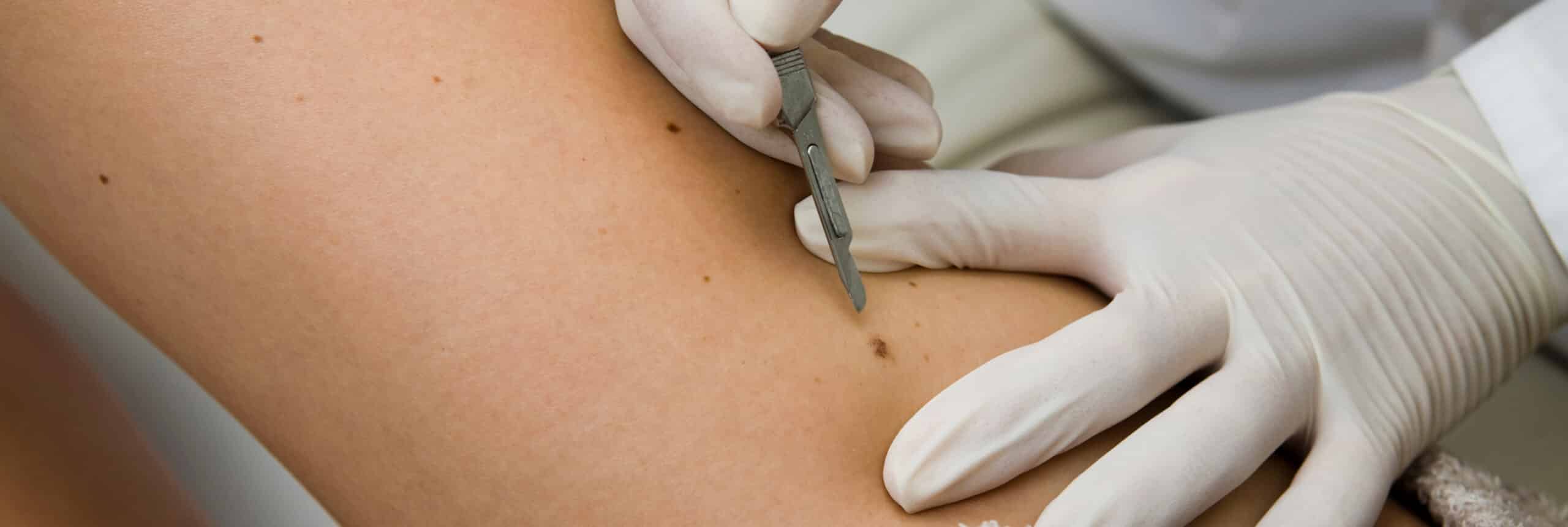 chirurgie dermato apres cancer