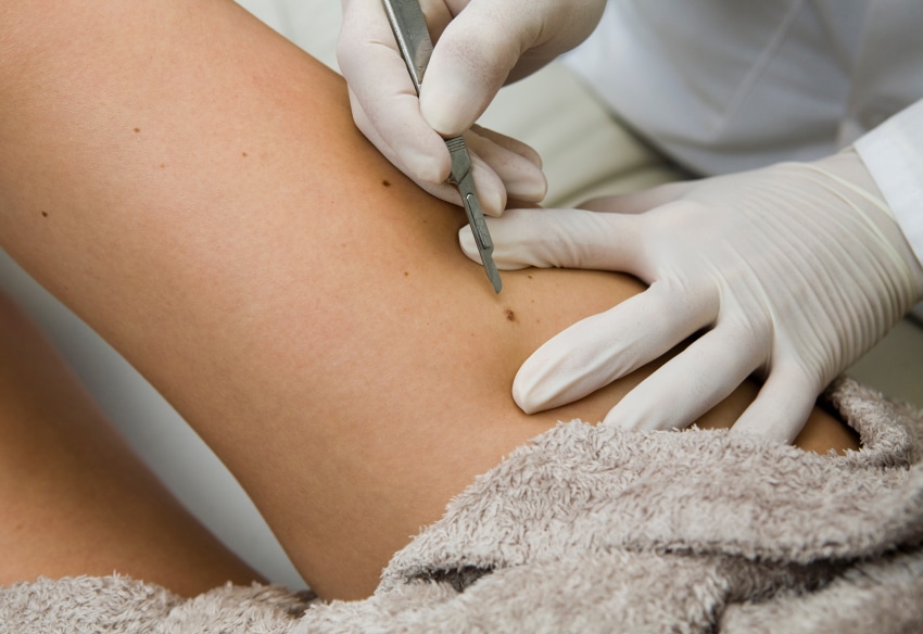 chirurgie dermato apres cancer