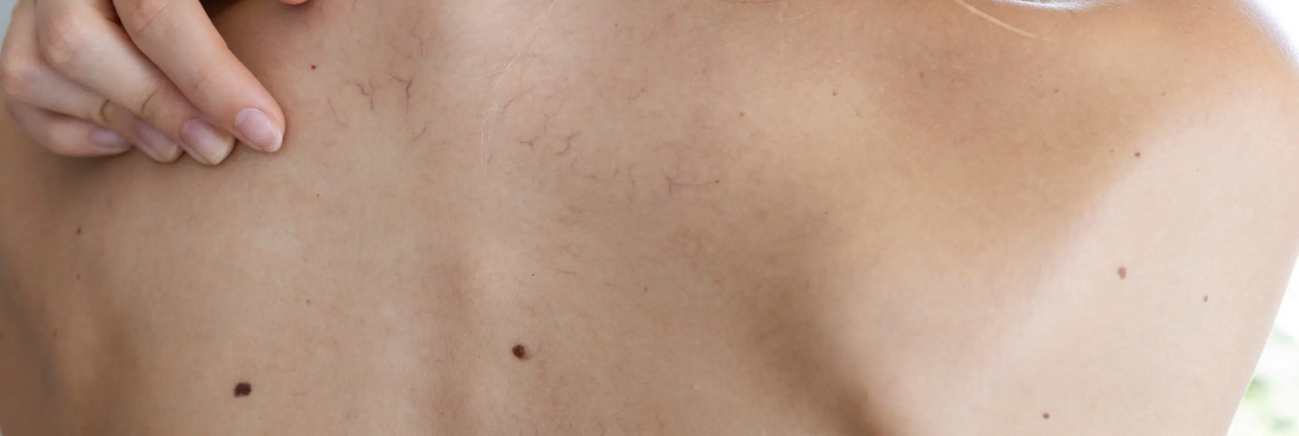chirurgie dermatologique pour peaux sensibles précautions conseils | Anaderm | Paris