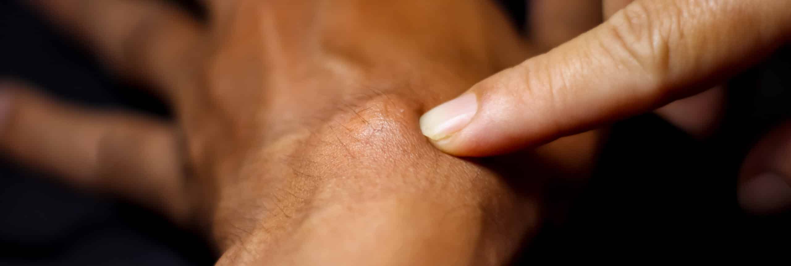 kystes démêler vrai faux | SurgiSkin | Paris