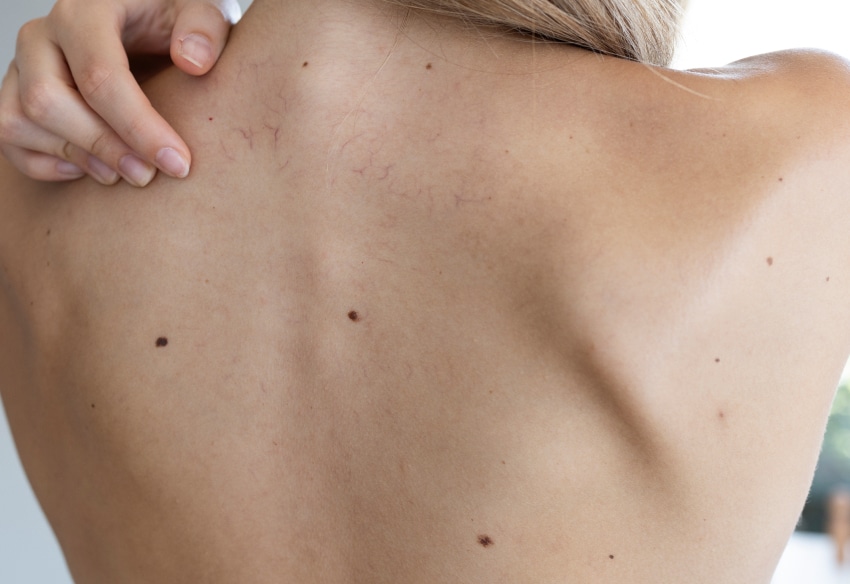 chirurgie dermatologique pour peaux sensibles précautions conseils | SurgiSkin | Paris