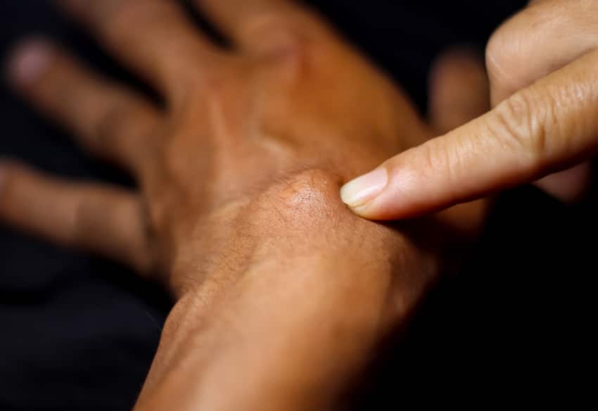 kystes démêler vrai faux | SurgiSkin | Paris