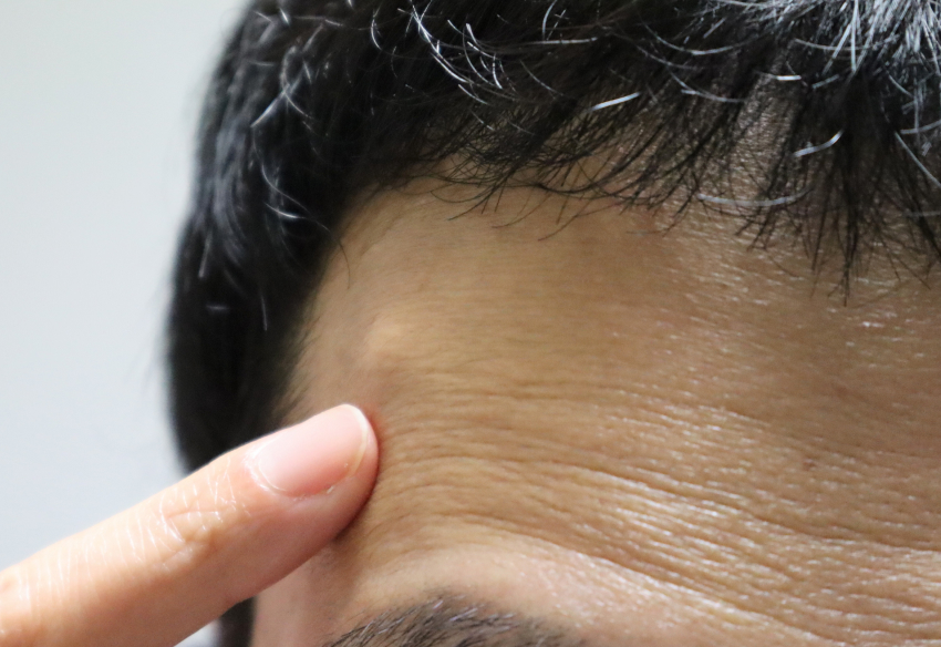 quels sont risques complications après ablation lipome | SurgiSkin | Paris