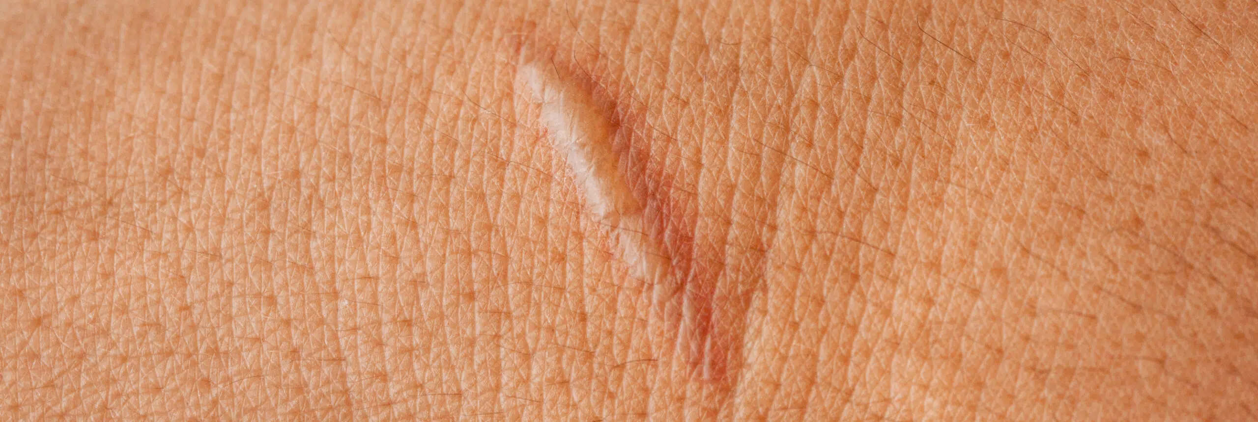 combien temps dure cicatrisation après chirurgie dermatologique | Anaderm | Paris